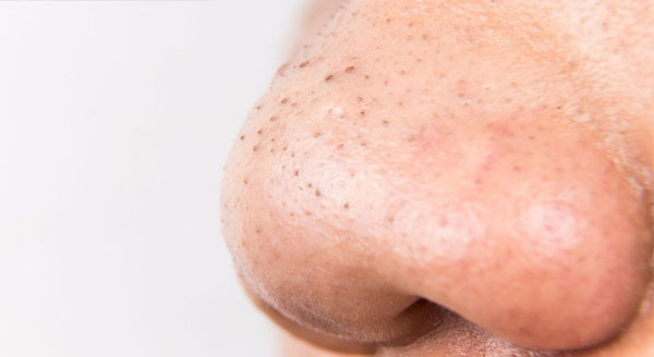 Mụn đầu đen thường tập trung chính ở vùng mũi